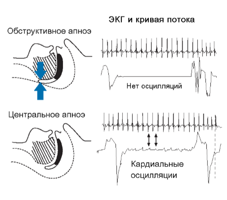 Что лучше для лечения храпа и апноэ – СИПАП или стоматологические капы