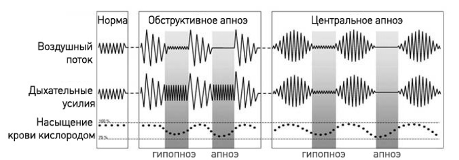 Центральное апноэ сна. Обструктивное и центральное апноэ. Паттерны нормального дыхания. Типы дыхания схема.