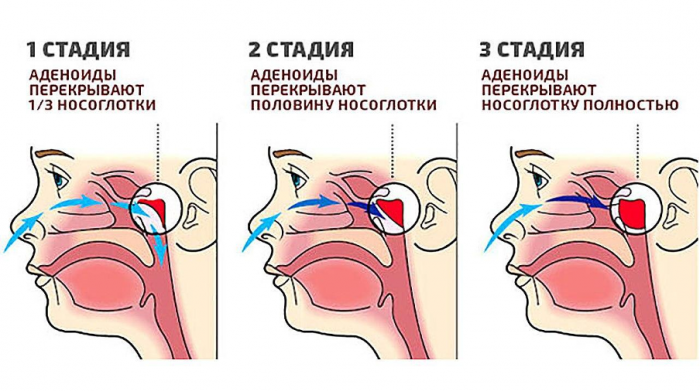 ХРАП У РЕБЁНКА