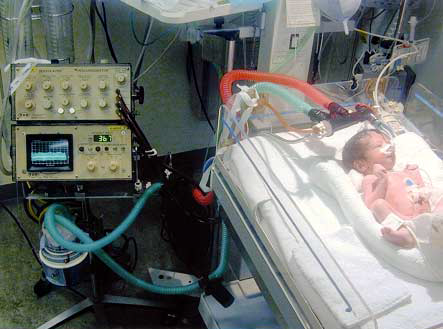 Возможности интрапульмональной перкуссионной вентиляции