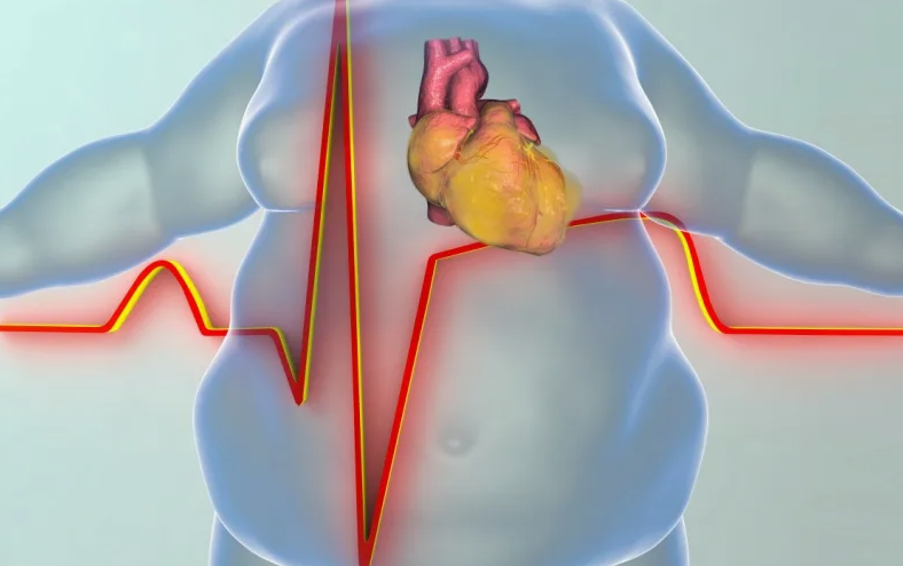 Ожирение — весомый фактор риска развития сердечных заболеваний Ожирение — весомый фактор риска развития сердечных заболеваний