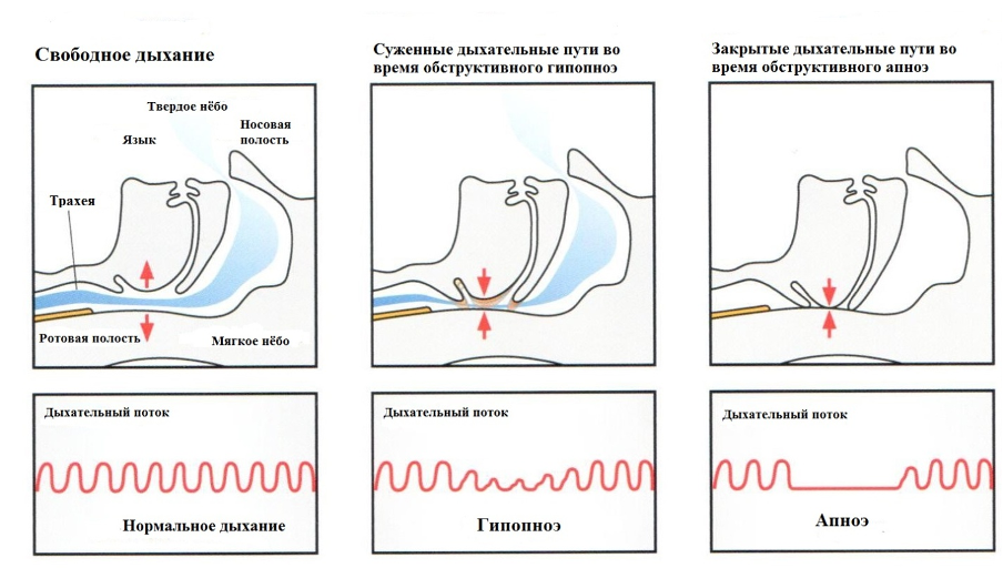 1_6.png Интенсивность воздушного потока при респираторных эпизодах