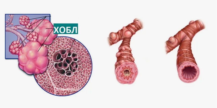 Эмфизема легких и сужение просвета бронхов при ХОБЛ