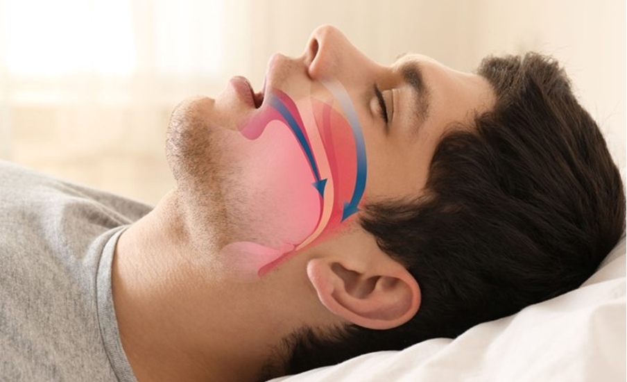 Частая причина храпа - слабый тонус глоточных мышц и мягкого нёба Частая причина храпа - слабый тонус глоточных мышц и мягкого нёба