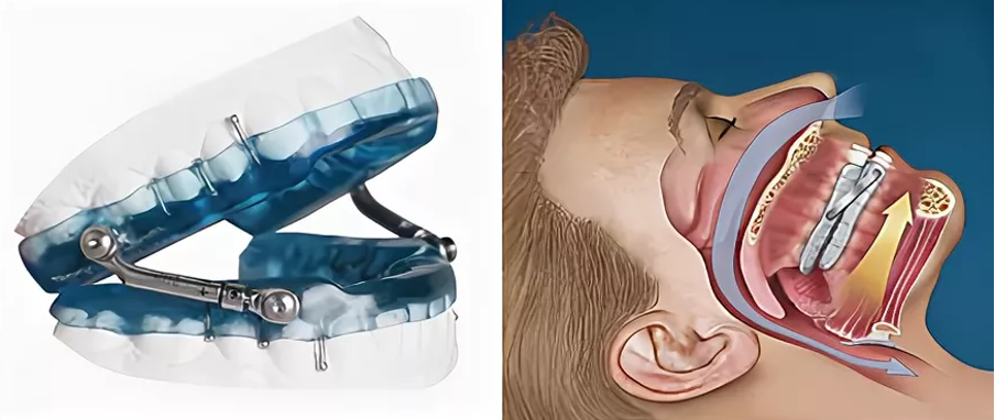 Капа выдвигает нижнюю челюсть и препятствует западанию мягких тканей в дыхательный просвет Капа выдвигает нижнюю челюсть и препятствует западанию мягких тканей в дыхательный просвет