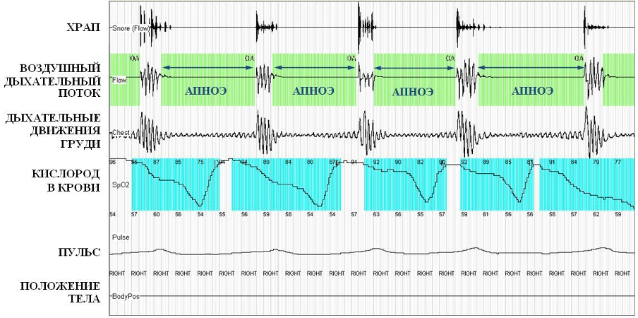 4_6.png Результаты кардио-респираторного мониторинга