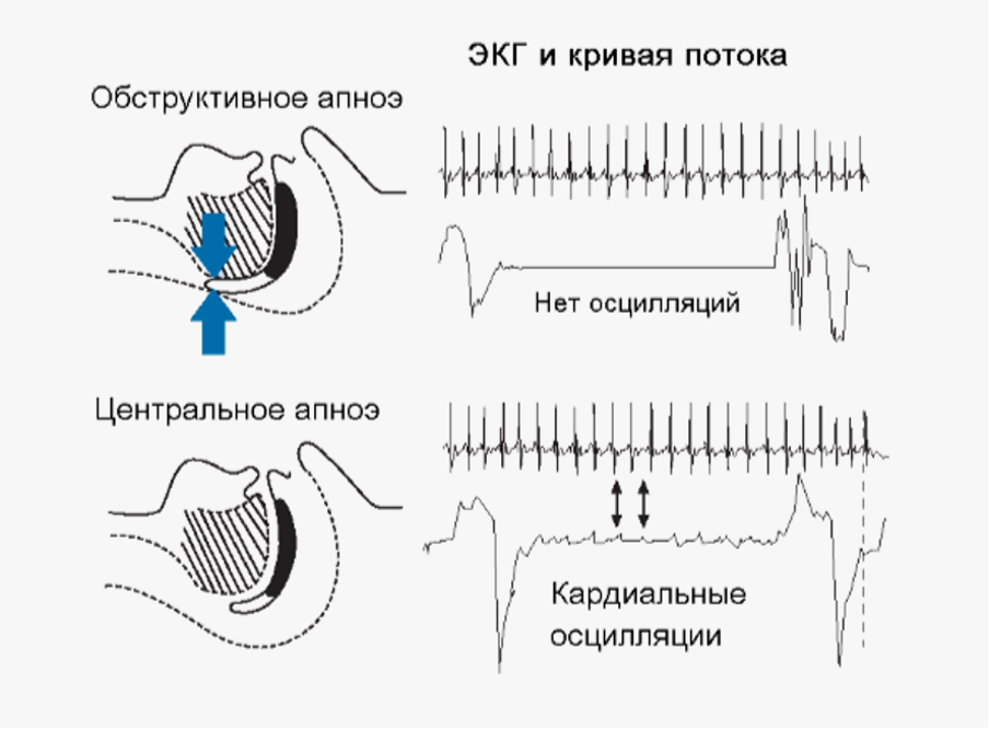 Разница между центральным и обструктивным апноэ