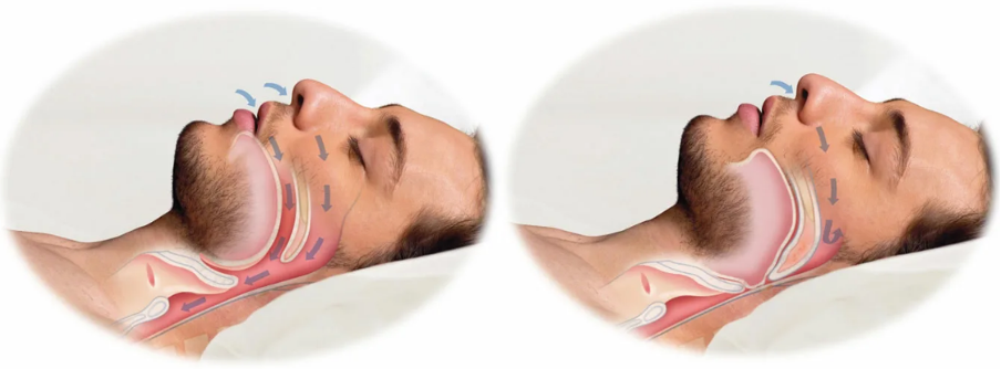 4_1.png Как происходит обструкция глотки