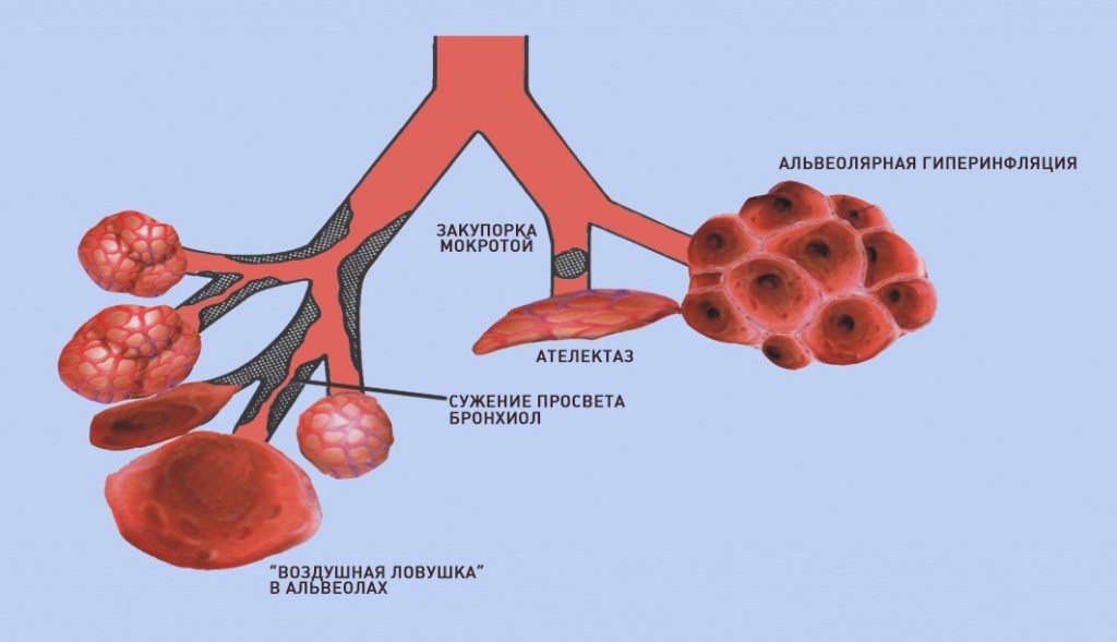 preferential airway.jpg preferential airway.jpg