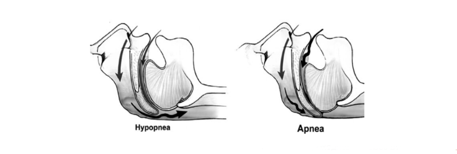 Механизм апноэ и гипопноэ Механизм апноэ и гипопноэ