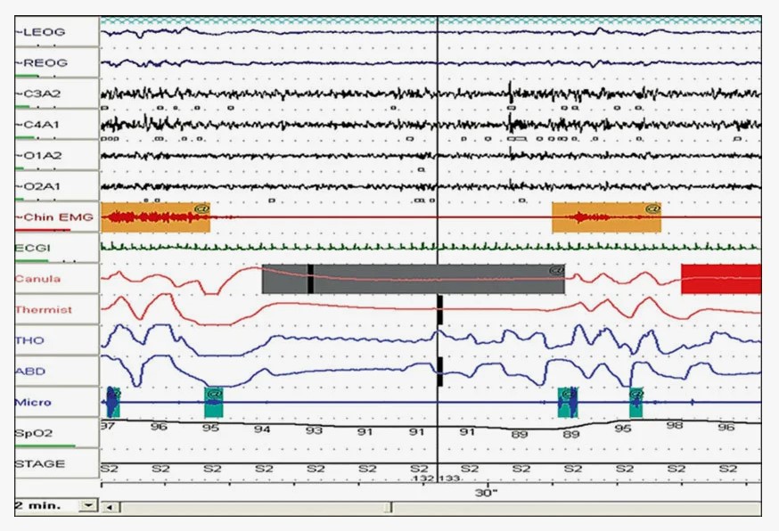2-5-po-rezultatam-polisomnografii.jpg По результатам полисомнографии можно воссоздать полную картину сна