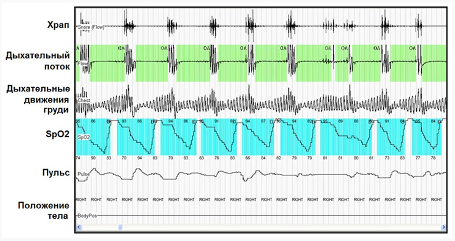 Пример данных кардиореспираторного мониторинга Пример данных кардиореспираторного мониторинга