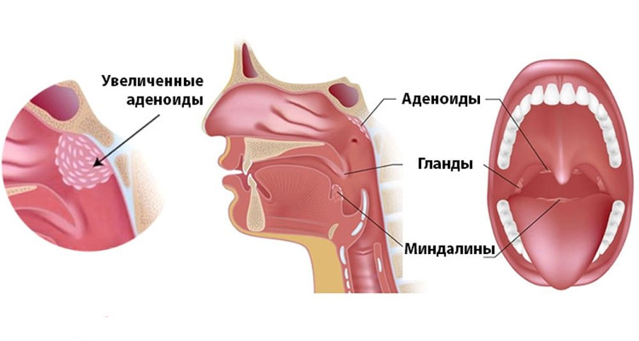 Аденоидит и тонзиллит могут вызвать частичную обструкцию глотки Аденоидит и тонзиллит могут вызвать частичную обструкцию глотки