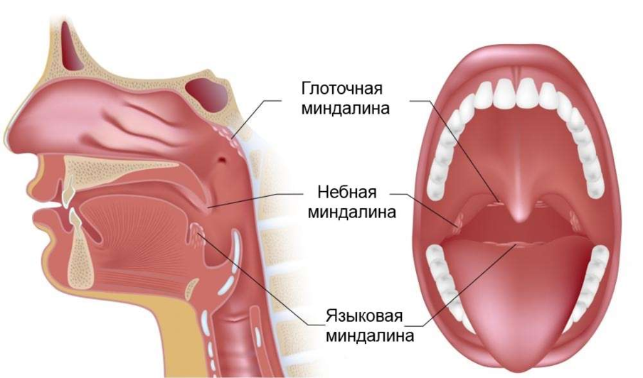 Гипертрофия миндалин может вызвать обструкцию дыхательных путей Гипертрофия миндалин может вызвать обструкцию дыхательных путей