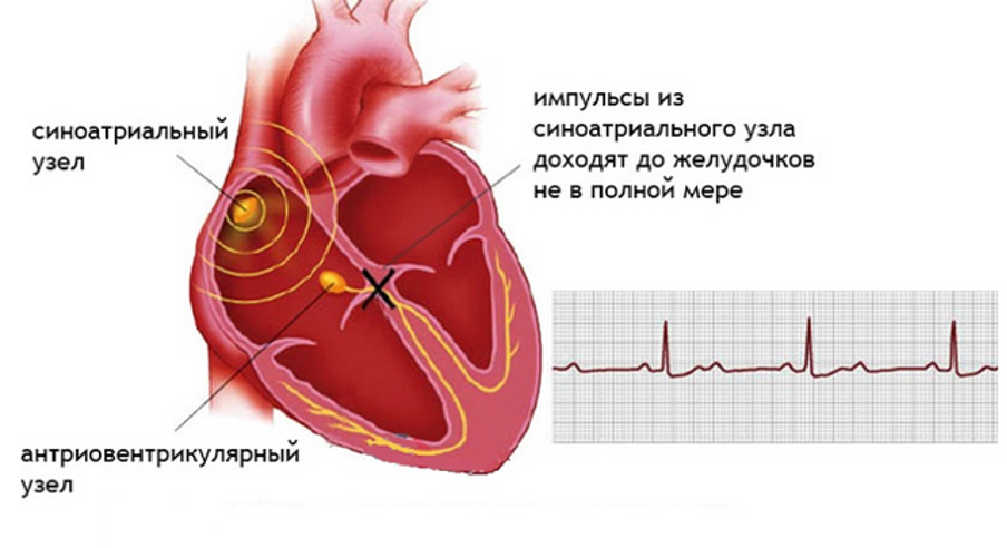 Механизм атриовентрикулярной блокады Механизм атриовентрикулярной блокады