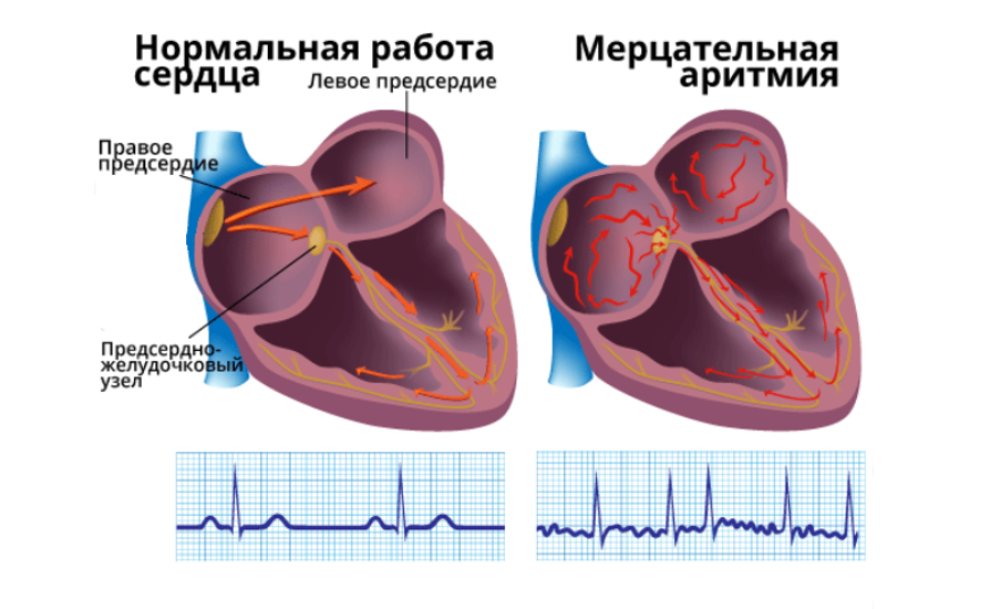 Мерцательная аритмия бывает одним из осложнений СОАС Мерцательная аритмия бывает одним из осложнений СОАС