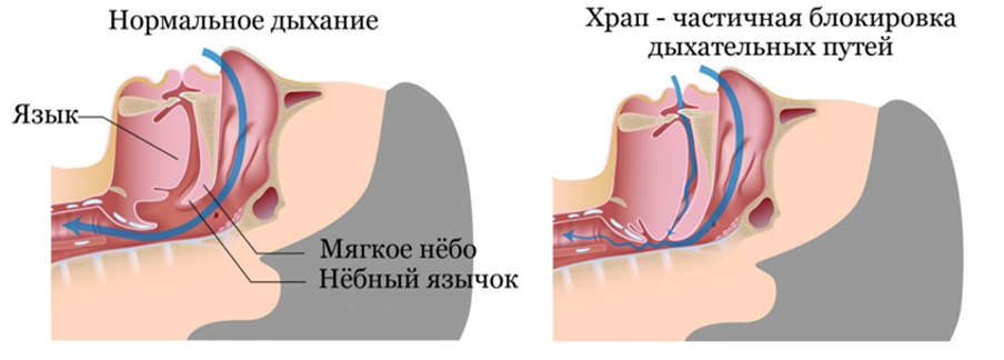 Патогенез храпа и СОАС Патогенез храпа и СОАС