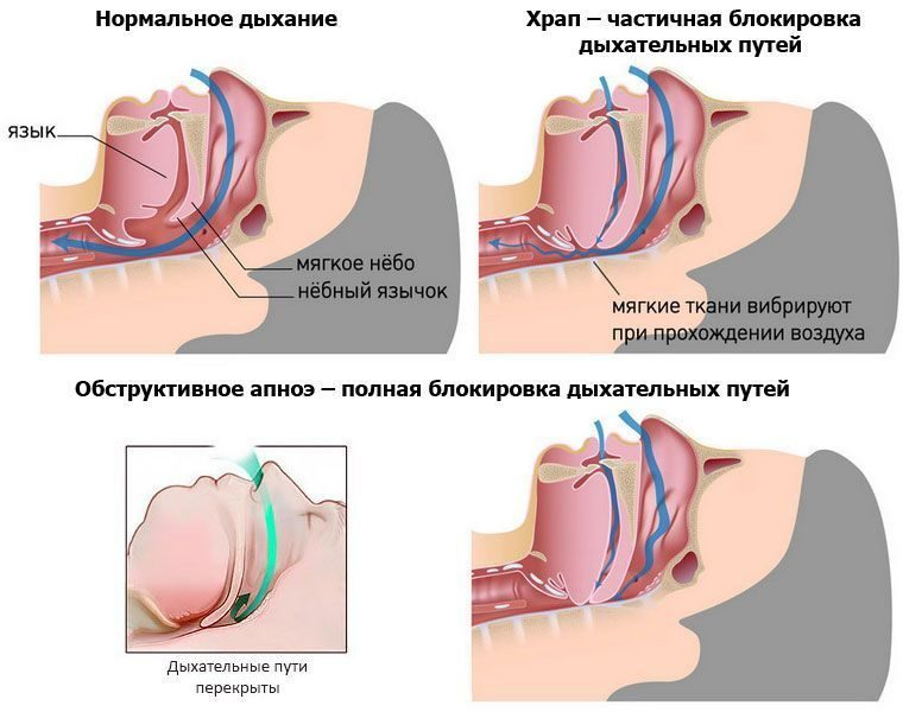 Механизм развития обструктивного апноэ Механизм развития обструктивного апноэ