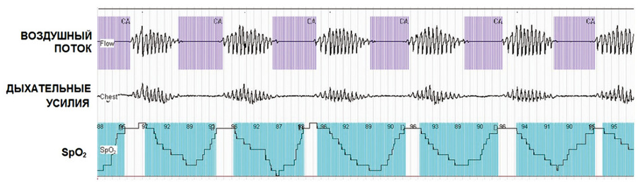 Запись ночного дыхания Чейна-Стокса в ходе полиграфии