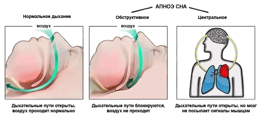Маска при апноэ и Сипап